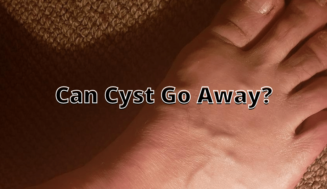 Can Cyst Go Away? ⏬ð