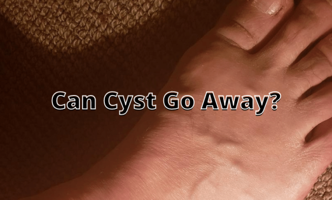 Can Cyst Go Away? ⏬👇 img
